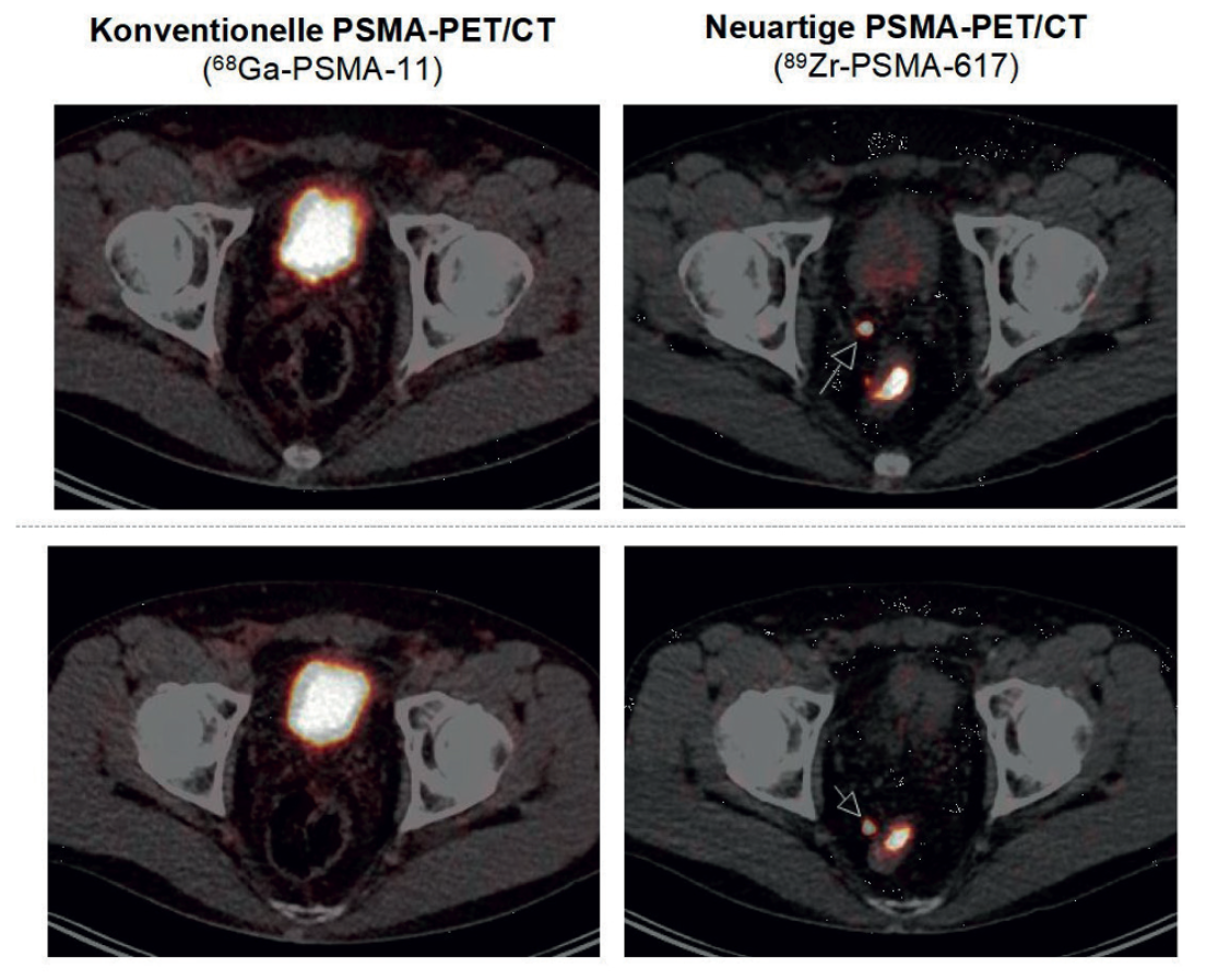Vergleich konventionelle PSMA-PET/CT (68Ga-PSMA-11) und neuartige PSMA-PET/CT (89Zr-PSMA-617)